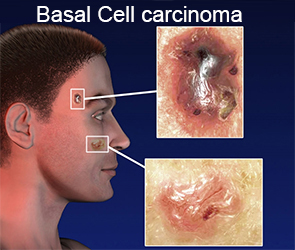 Basal-cell-carcinoma-Tunisia